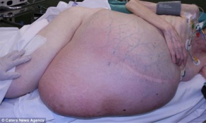Kinh hãi với khối u nặng 38kg lấy từ bụng của một phụ nữ