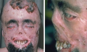 Người đàn ông bị biến dạng mặt nặng nề bởi căn bệnh ma cà rồng