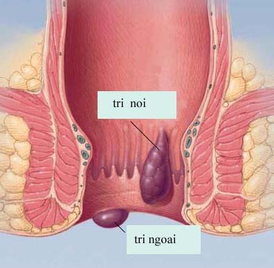 Bệnh trĩ và phương pháp điều trị hiệu quả