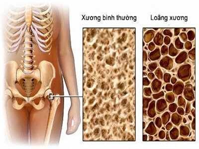 Hiểu đúng để phòng ngừa bệnh xốp xương