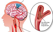 Ðề phòng rối loạn tuần hoàn não