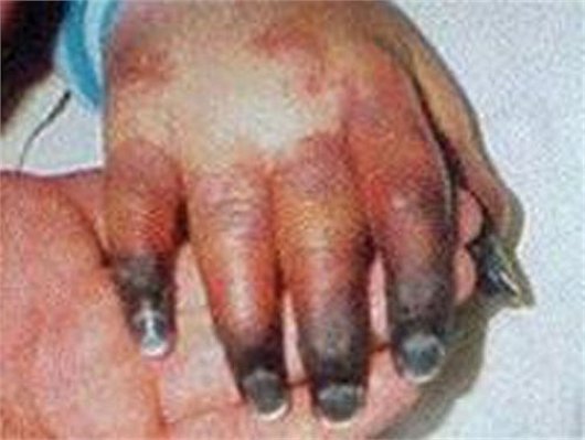 Hãi hùng hình ảnh cắt bỏ chân tay, da mặt vì vi khuẩn ăn thịt người