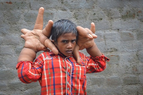 Cậu bé Ấn Độ có đôi bàn tay khổng lồ, nặng 16 kg