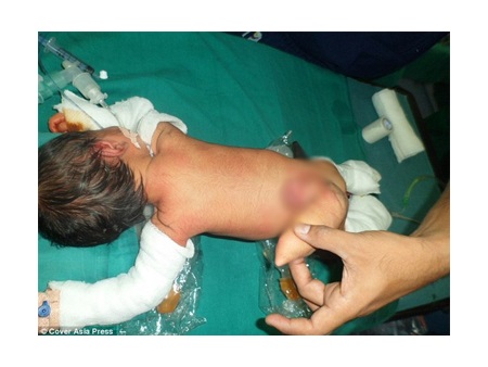Bé sơ sinh có đuôi dài ở Ấn Độ được phẫu thuật