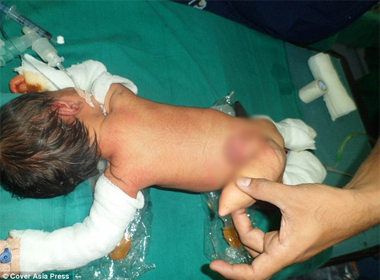 Bé sơ sinh có đuôi dài ở Ấn Độ được phẫu thuật
