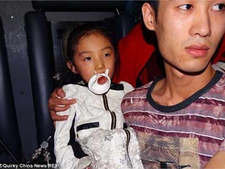 Bé gái 6 tuổi bị mắc kẹt lưỡi trong... nắp cốc nhựa