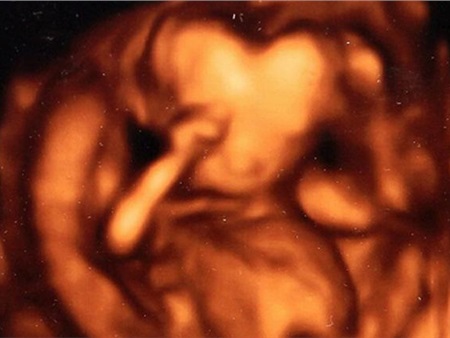 Hoảng hốt khi hình ảnh thai nhi có đầu hình trái tim