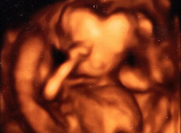 Hoảng hốt khi hình ảnh thai nhi có đầu hình trái tim