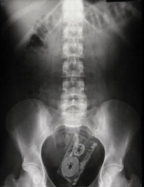 Sốc với vật nhọn nằm gọn trong cơ thể qua hình chụp X-quang
