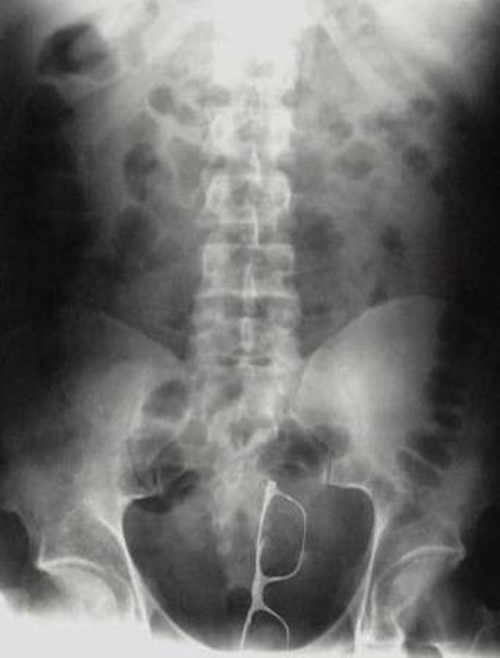 Sốc với vật nhọn nằm gọn trong cơ thể qua hình chụp X-quang