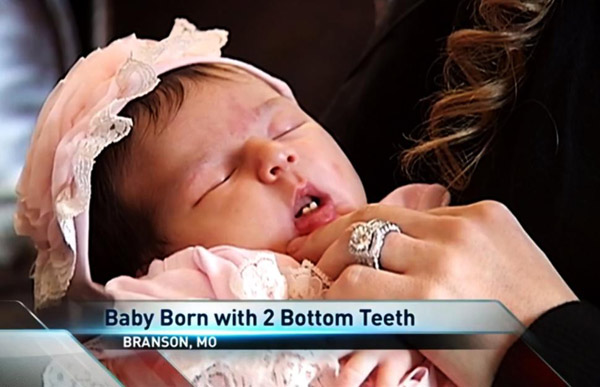 Bé sơ sinh chào đời đã có hai răng