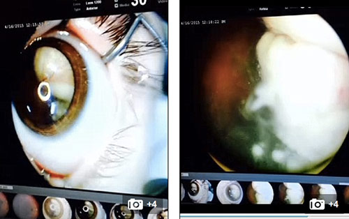 Bố Việt cảnh báo cha mẹ kiểm tra ung thư mắt trẻ bằng iphone