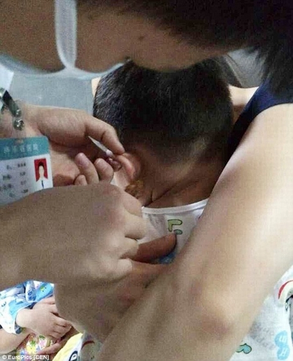 Cha mẹ sốc nặng khi con trai 4 tuổi bị cô giáo mầm non bấm ghim vào tai