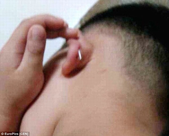 Cha mẹ sốc nặng khi con trai 4 tuổi bị cô giáo mầm non bấm ghim vào tai