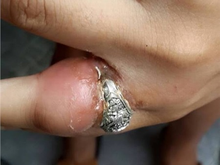 Ghê rợn ngón tay bị viêm nhiễm do đeo nhẫn quá chật