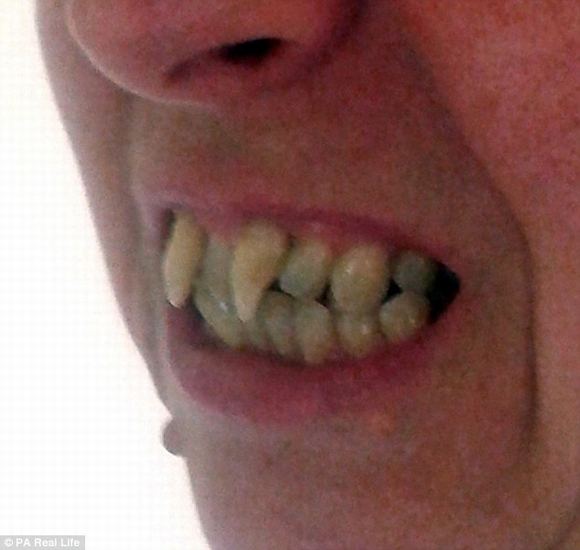 Người phụ nữ biến thành 'ma cà rồng' vì bệnh nướu răng
