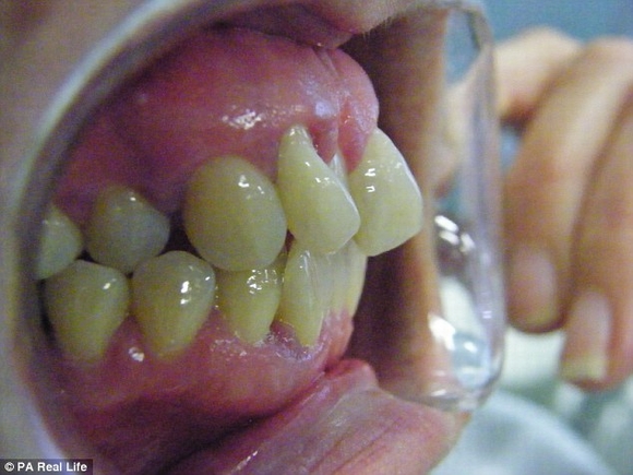 Người phụ nữ biến thành 'ma cà rồng' vì bệnh nướu răng