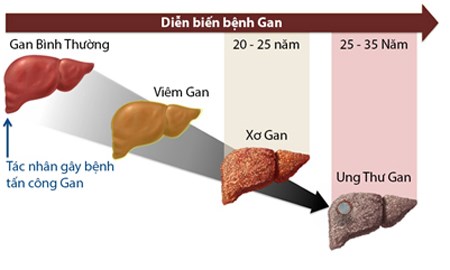 Bác sĩ giật mình với hình ảnh gan biến dạng vì rượu