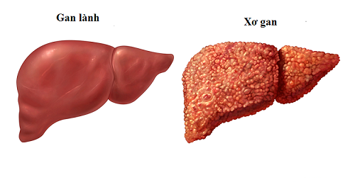 Bác sĩ giật mình với hình ảnh gan biến dạng vì rượu