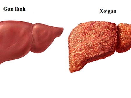 Bác sĩ giật mình với hình ảnh gan biến dạng vì rượu