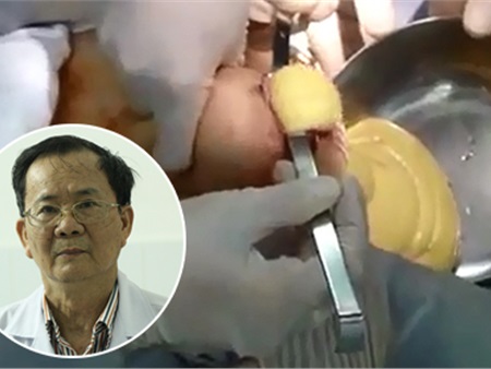 Bác sĩ thẩm mỹ quay clip 'silicon chảy ra từ ngực' chia sẻ về ca phẫu thuật hi hữu