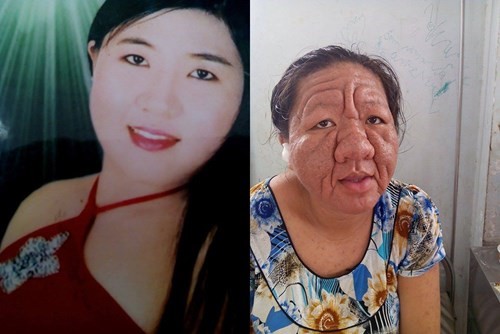 Thai phụ 29 tuổi hóa bà lão 70 vì tự ý bôi thuốc