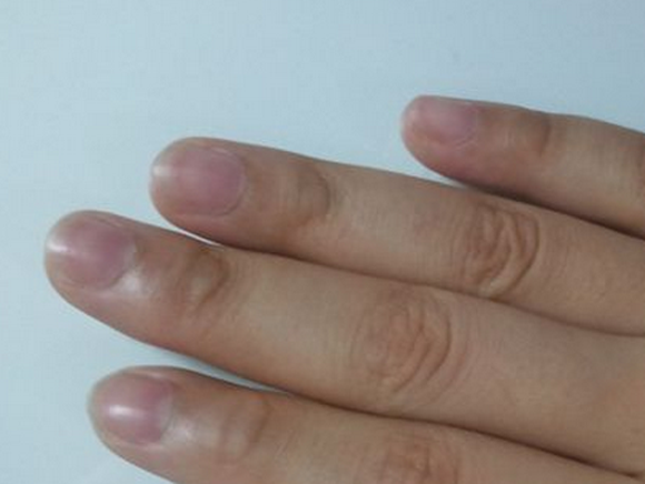 Những bệnh tiềm ẩn có thể phát hiện được khi nhìn ngón tay