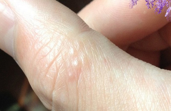 Những bệnh tiềm ẩn có thể phát hiện được khi nhìn ngón tay